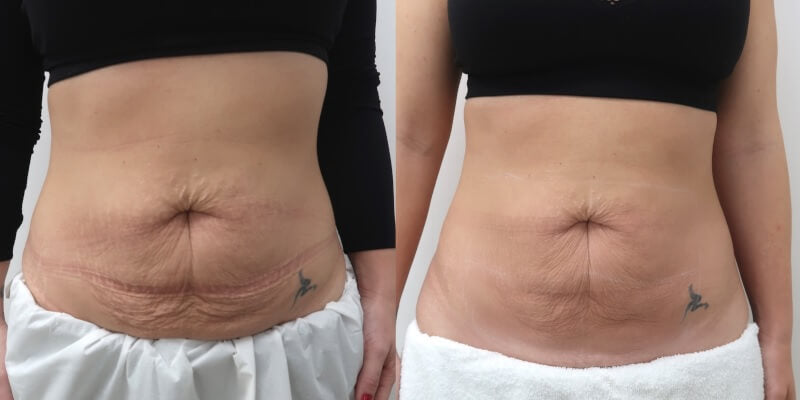 Before and after photos shared by Lauren M.