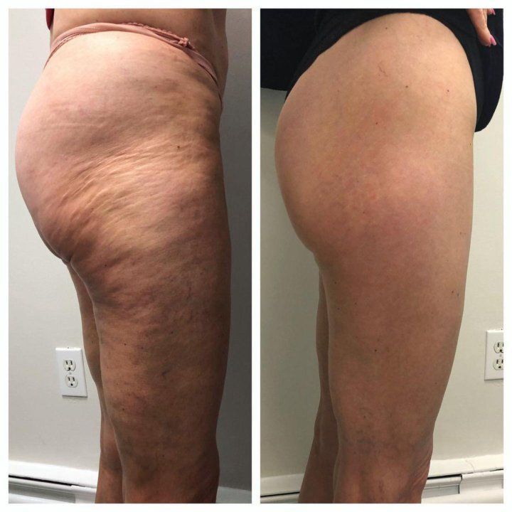 Before and after photos shared by Nicole G.